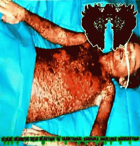 Carcinomas Of Unknown Primary Origin : Severe Necrotic Skin Reaction to Traditional Vaccinia Smallpox Vaccination